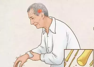 Progresso Rivoluzionario nella Cura del Parkinson con Cellule Staminali Indotte