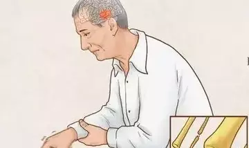 Progresso Rivoluzionario nella Cura del Parkinson con Cellule Staminali Indotte